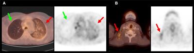 Diagnostic Value of Positron Emission Tomography Combined with Computed Tomography for Evaluating Critically Ill Neurological Patients